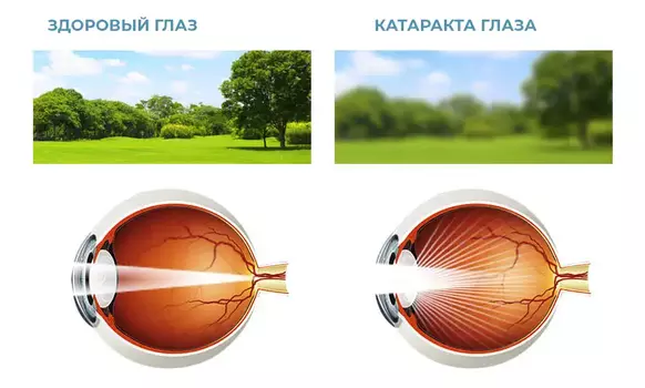 Удаление катаракты у пациентов с сопутствующими заболеваниями